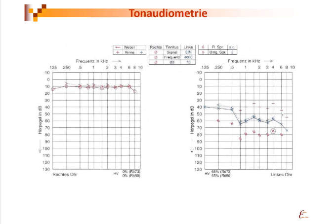 tonaudiometrie